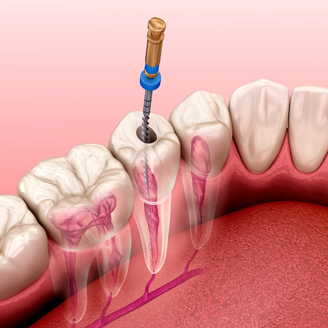 endodoncia en clinica dental canet de mar
