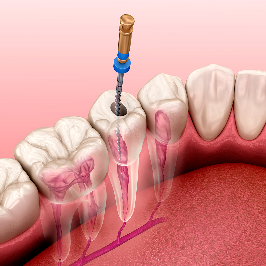 endodoncia en clinica dental canet de mar