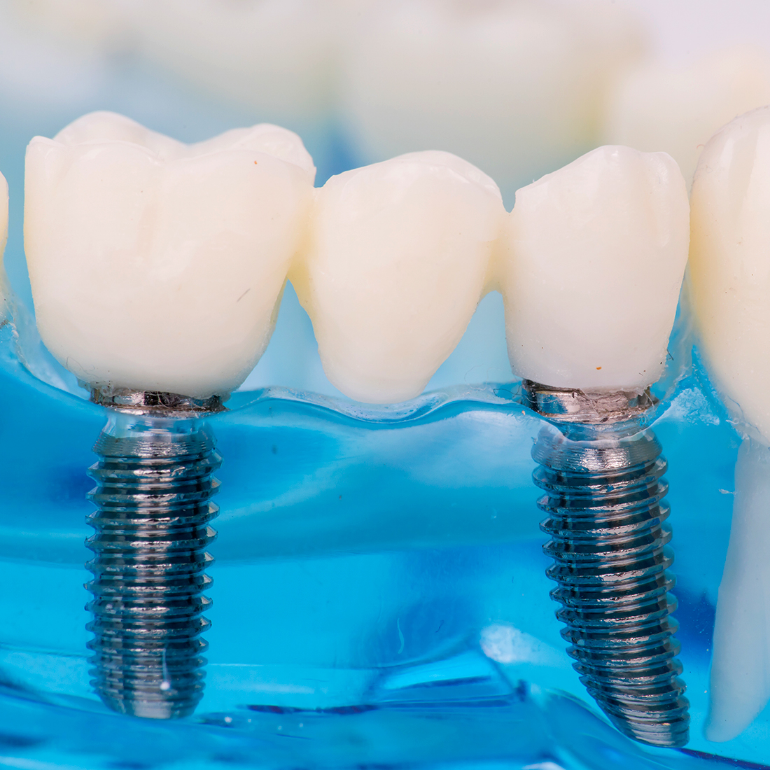 implantes en canet de mar